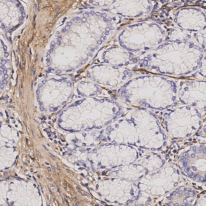 Image of cells in pancreatic cancer