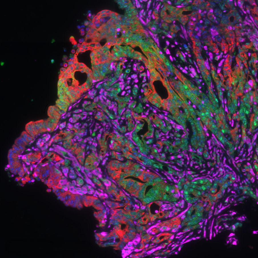 A Pancreatic cancer image