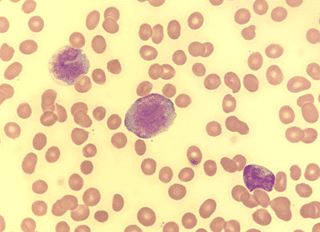 Enhancer activation by pharmacologic displacement of LSD1 from GFI1 induces differentiation in acute myeloid leukemia