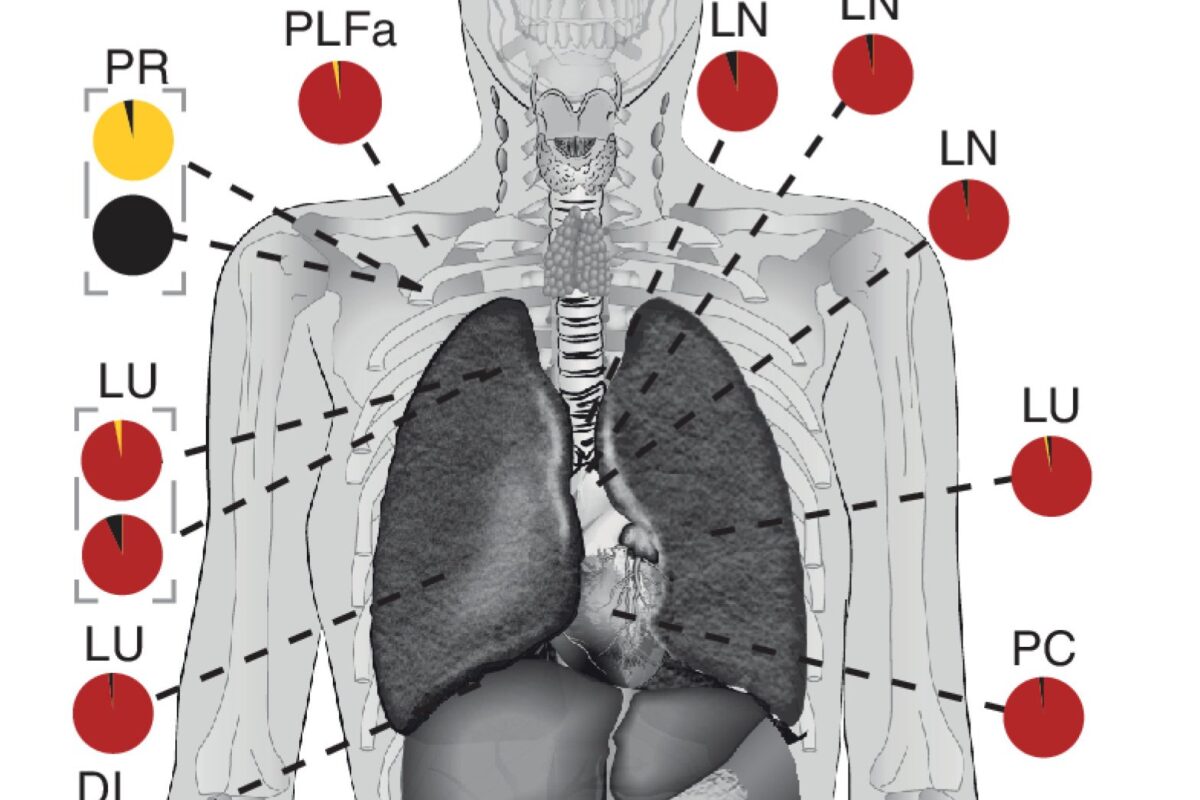 A graphical representation of a person with coloured circles indicating the location and prevalence of metastatic clones that have spread to different parts of the body
