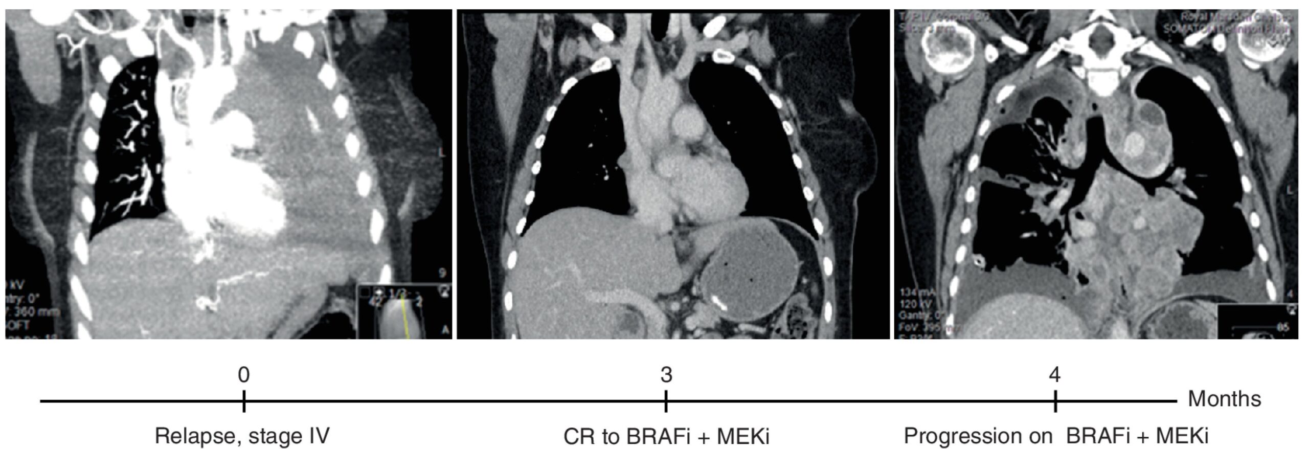Radiologic images of a patient indicating thorax upon initiation of stage IV metastatic melanoma, showing complete extracranial response to BRAF inhibitor, followed by rapid recolonization of the thorax with resistant clones (left to right)