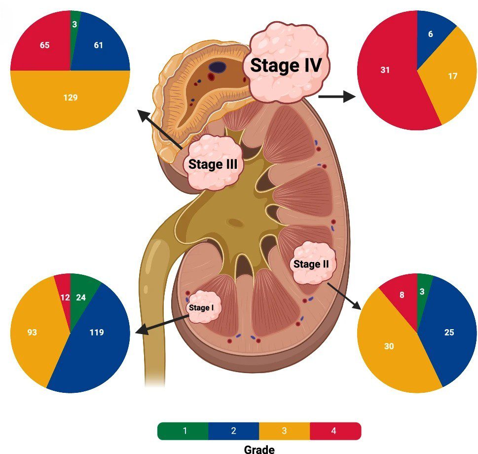 Graphic image of kidney showing overview of cohort of renal cancer patients in the 100,000 Genomes Project