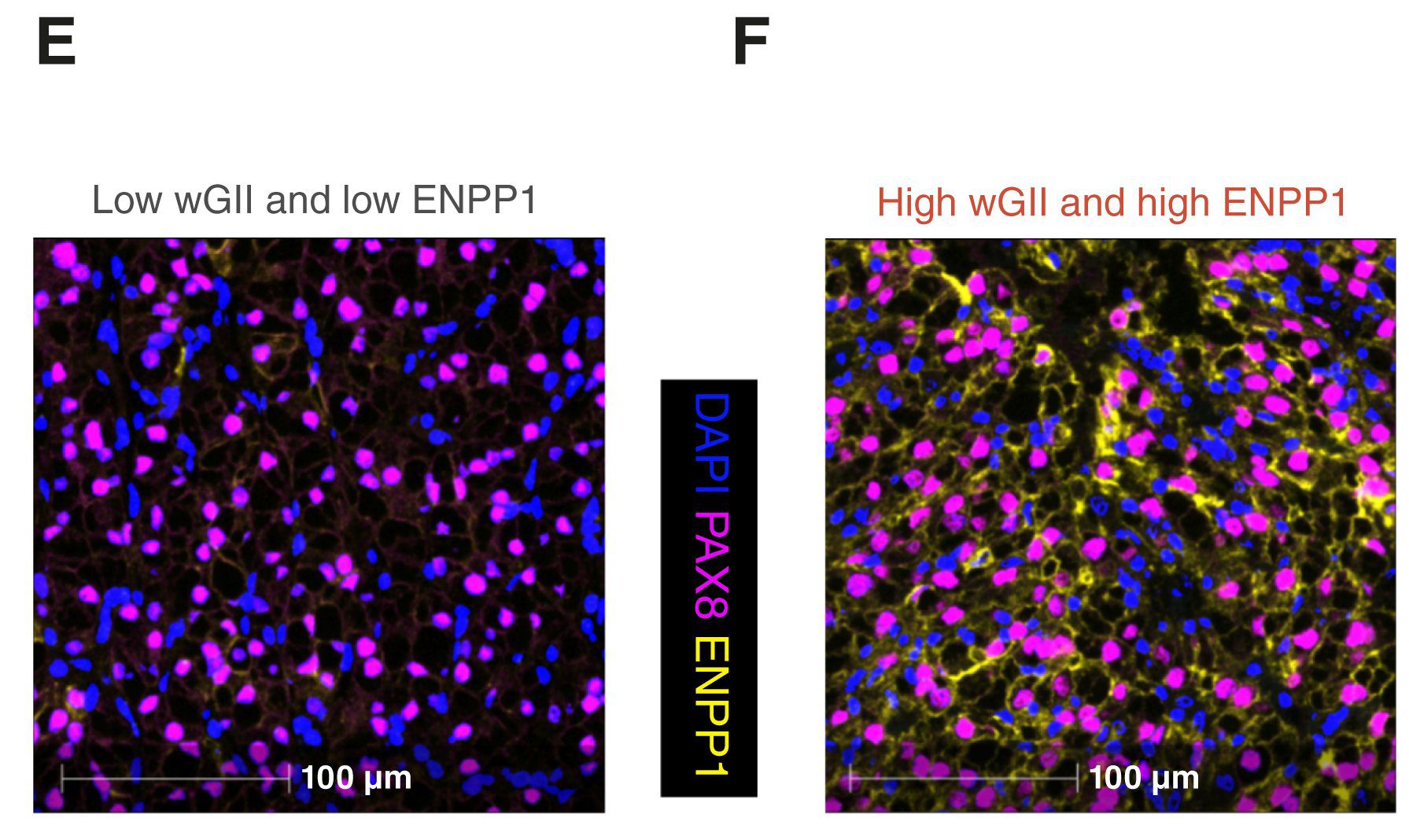E and F, Representative MIF images of TRACERx Renal tumor samples (E) with low wGII and (F) with high wGII. PAX8, a marker of ccRCC cells, is colored in magenta, ENPP1 is in yellow, and DAPI is in blue.