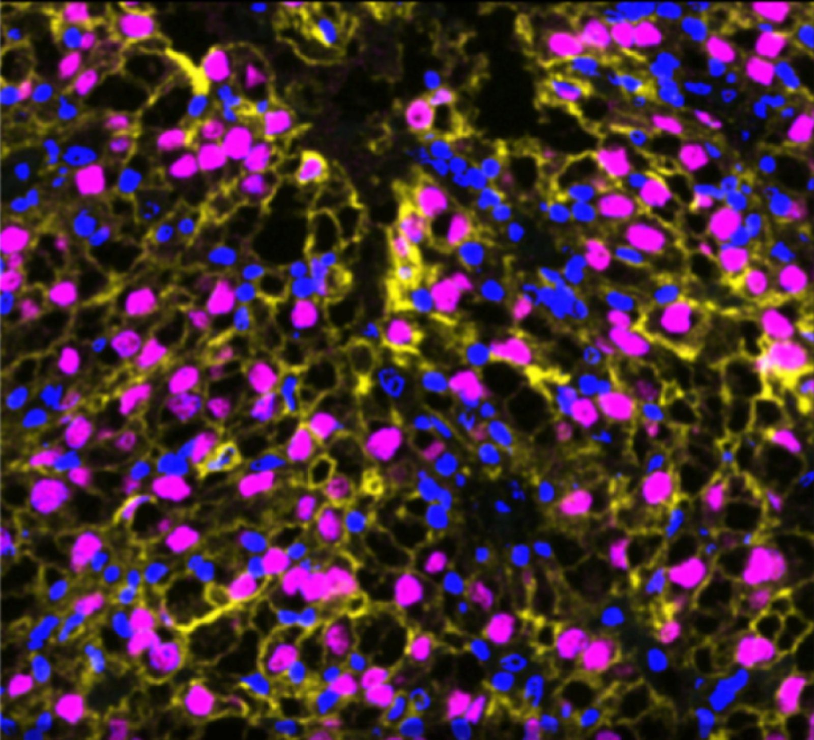 Representative MIF images of TRACERx Renal tumor samples with high wGII