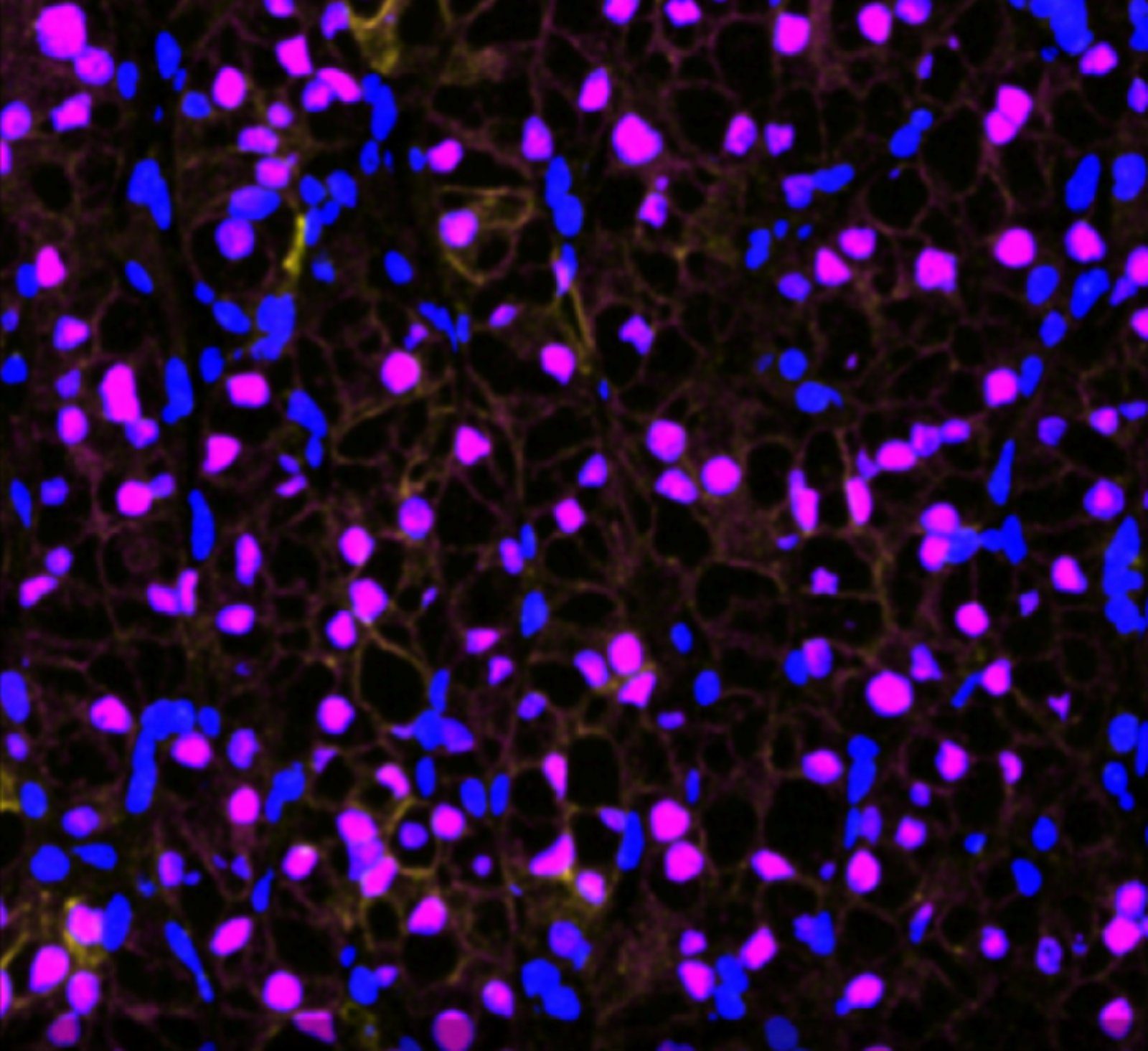 Representative MIF images of TRACERx Renal tumor samples with low wGII