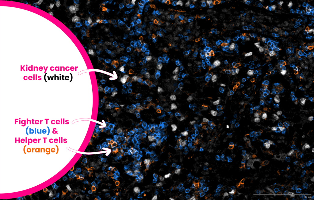 This image is of a kidney tumour; the white cells are tumour cells, blue cells are 'fighter' T cells (of the subtype CD8) and orange are 'helper' T cells (of the subtype CD4). This image shows strong infiltration of the immune cells into the kidney tumour.